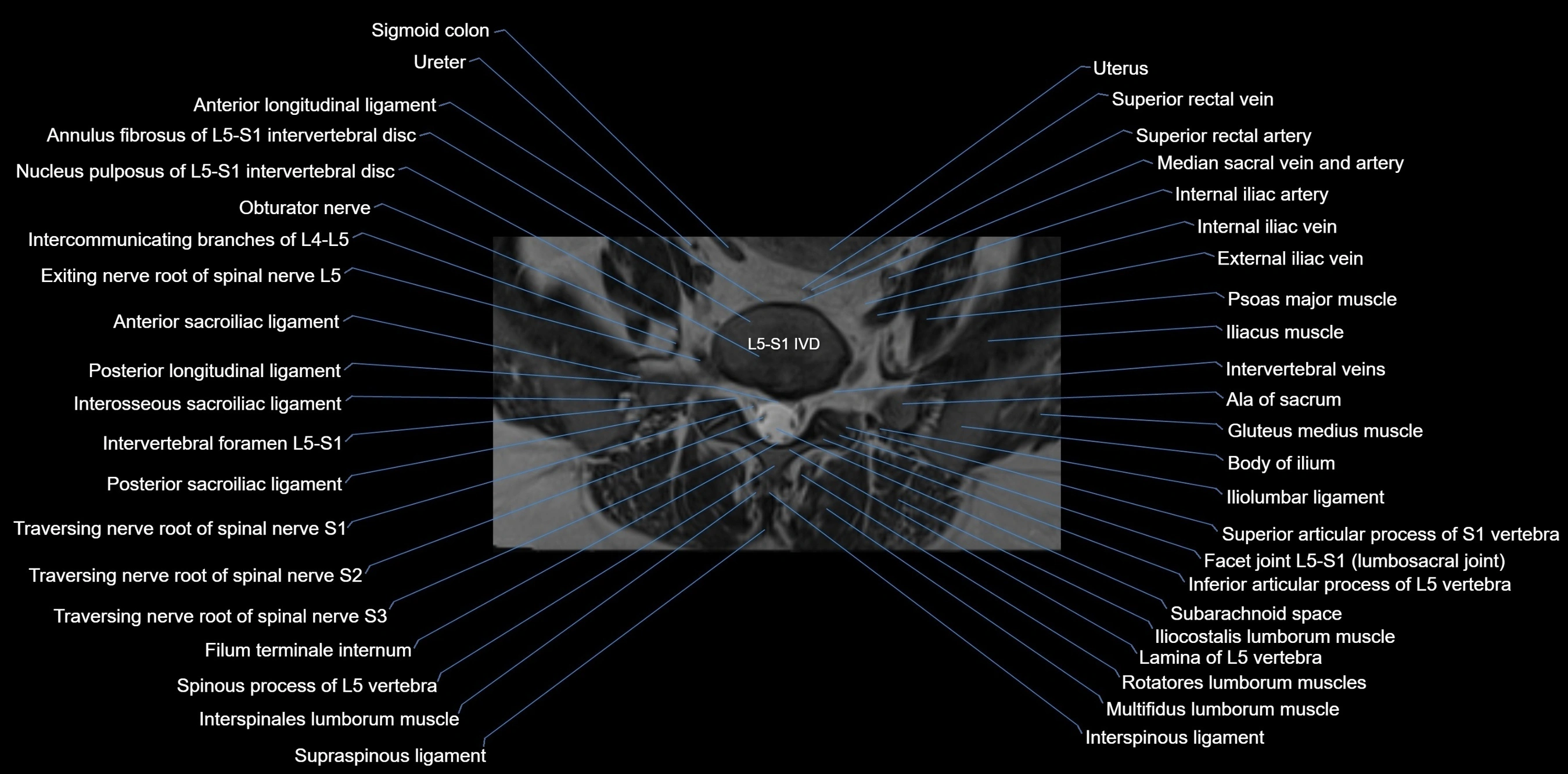 MRI sacrum, coccyx and sacroiliac joint axial cross sectional anatomy 3T  radiology  image-img-00001-00007.webp